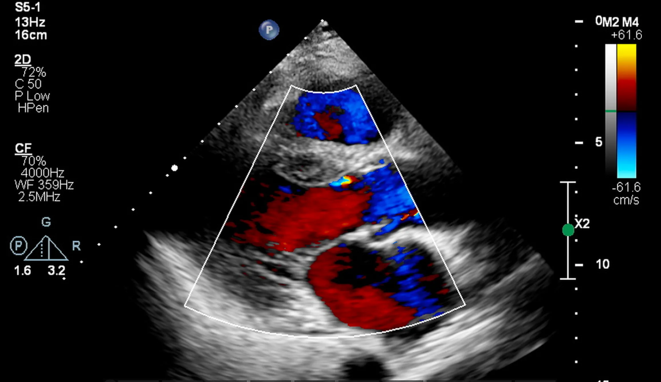 Imagem de ecocardiograma mostrando detalhes da estrutura e função do coração, usada para diagnóstico de condições cardíacas na Clínica Biocardio.