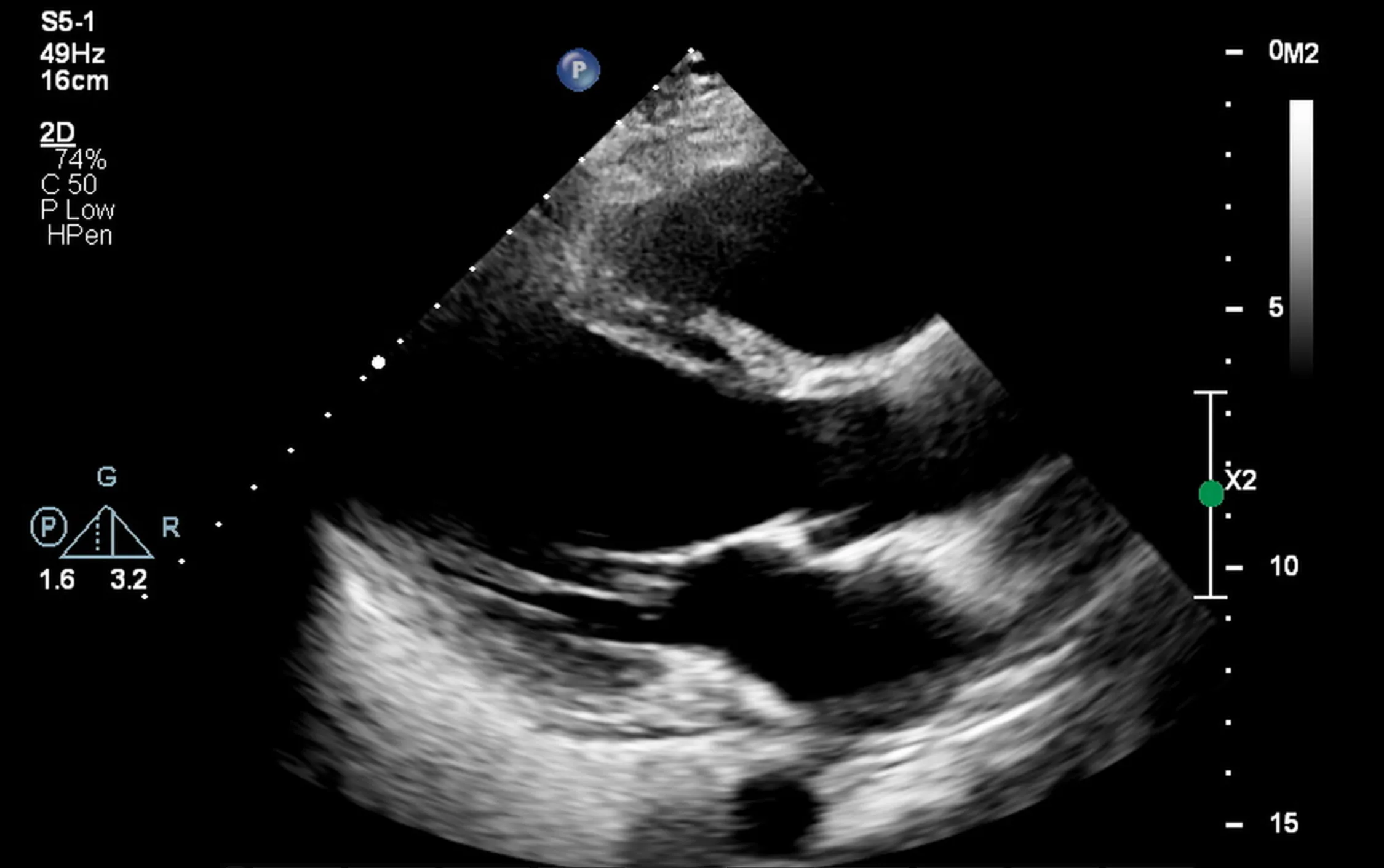 Imagem de ecocardiograma mostrando detalhes da estrutura e função do coração, usada para diagnóstico de condições cardíacas na Clínica Biocardio.
